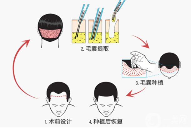 植發(fā)的*果是*性的嗎 它的原理是什么？