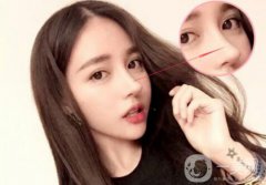 歪鼻矯正手術(shù)是怎樣的 手術(shù)方法有哪些？