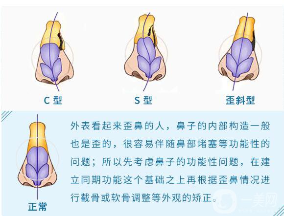 歪鼻矯正手術(shù)是怎樣的 手術(shù)方法有哪些？