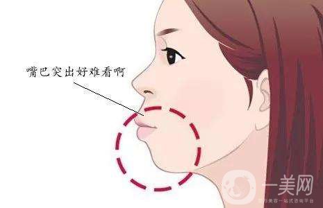 雙頜前突是什么 凸嘴不好看該怎么辦？