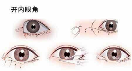 開(kāi)眼角的風(fēng)險(xiǎn)大嗎 開(kāi)眼角*果好不好