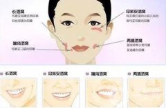 酒窩整形價格多少錢？多久恢復？
