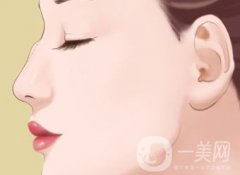 駝峰鼻手術(shù)價(jià)格一般是多少？