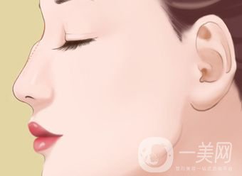 駝峰鼻手術(shù)價格一般是多少？