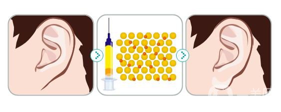 注射玻尿酸豐耳垂前后 豐耳垂*果好不好？