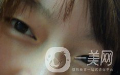 上海九院張波醫(yī)生好不好？醫(yī)生雙眼皮案例附照片