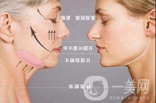 面部提升手術費用