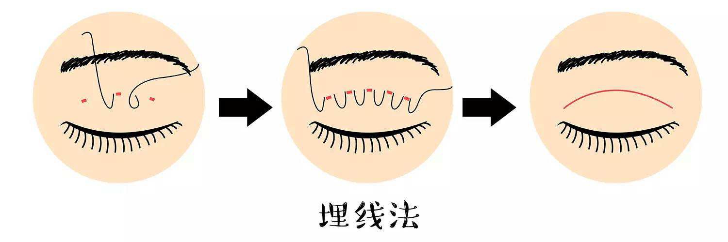 不開刀的雙眼皮手術(shù)有哪些？