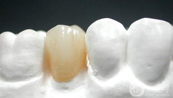 烤瓷牙一般要多少錢 貴不貴？
