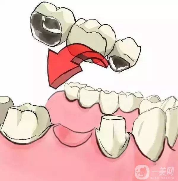 烤瓷牙一般要多少錢 貴不貴？