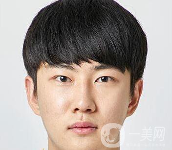 男人隆鼻前后附照片 隆鼻*果好嗎？