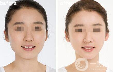 　　什么是短下巴手術(shù)?如果前下巴下陷，就用手術(shù)切下巴，把下巴向前移動。這種定制的手術(shù)使下巴向前移動，通過諸如前進(jìn)、T截骨和假體插入等步驟，使面部線條自然而美觀，這取決于個(gè)人的下巴狀況。短下巴手術(shù)，以移動下巴尖向前，糾正不明確的下巴線，并改良你的臉，如果你的牙齒遮擋是好的，盡管你的下陷下巴。  什么是短下巴手術(shù) 短下巴手術(shù)類型  　　短下巴手術(shù)認(rèn)為是一個(gè)短下巴(微頜)，如果下巴是下陷，牙合是差的。它可以通過雙頜截骨術(shù)(雙頜手術(shù))矯正，使整個(gè)下巴向前移動。  　　雙頜截骨術(shù)(雙頜手術(shù))的捷徑骨刀提高準(zhǔn)確性，骨手術(shù)刀是一種超聲波裝置，它只對骨組織起反應(yīng)作用，從而切割骨骼。它有較小的振動在0.5mm內(nèi)，使一個(gè)**的手術(shù)，保護(hù)附近的血管和神經(jīng)，只對骨骼作出反應(yīng)，造成較少的組織損傷和出血，并提供*。    　　這些人需要做短下巴手術(shù)：  　　1、如果你的下顎凹陷了  　　2、如果你的下顎很小  　　3、如果你有突出的上牙  　　4、如果你的下巴和脖子有一個(gè)不清楚的界限  　　5、如果你看起來像下巴上有很多脂肪，下巴很短，就會有皺紋。  　　6、如果你經(jīng)常聽到你看起來很遲鈍  　　短下巴手術(shù)類型  　　1、前下巴(下巴尖)前進(jìn)。這個(gè)過程把下陷的骨頭切成向前移動的長度。根據(jù)骨切除的角度調(diào)整下巴的長度，形成一條自然的下頜線。  　　2、把下陷的骨頭往前移。這一過程減少和糾正了下巴的寬度，使下巴線條更苗條、更漂亮。  　　3、集骨。收集切割的骨頭并向前移動。  　　4、刮去骨頭。平滑地研磨下巴線。  　　5、假體插入。這個(gè)過程通過口腔的一個(gè)小切口將塑造成下巴骨輪廓的假體插入到下巴骨的前側(cè)。