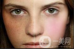 皮膚斑點：老年斑、鼴鼠、黃褐斑和雀斑的區(qū)別