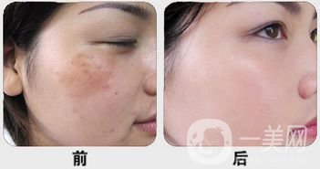 白瓷娃娃做完多久*果？幾次*果？