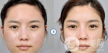 改變臉型手術(shù)要多少錢呢？