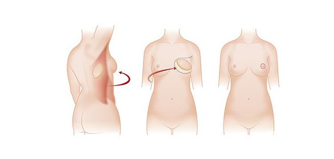 北京乳房再造術(shù)多少錢?*果維持多久？
