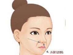 墊鼻基底有什么后遺癥?術(shù)后怎么護理?