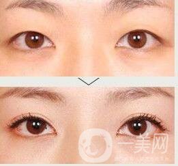 哪些人不適合做雙眼皮,雙眼皮價格,雙眼皮術后護理