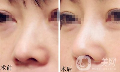 膨體隆鼻是終生的嗎？