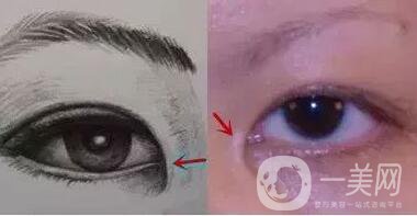 開眼角疼嗎？這幾種情況開眼角*果堪比換頭！