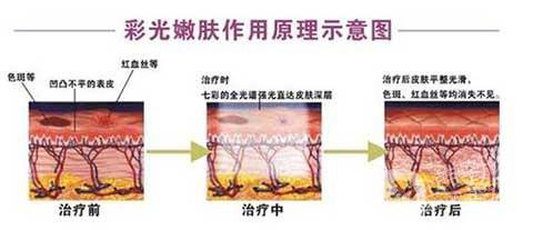 彩光嫩膚好嗎？*果如何？
