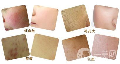 彩光嫩膚好嗎？*果如何？