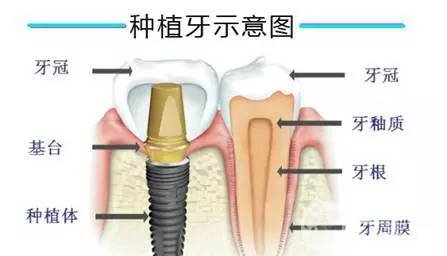 人工種植牙齒價(jià)格 手術(shù)費(fèi)用多少錢？