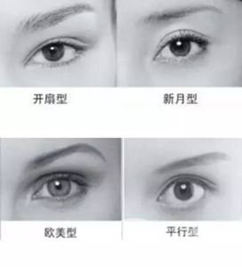 全切雙眼皮多久自然 手術(shù)有年齡限制嗎？