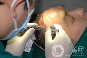植發(fā)費(fèi)用多少錢 價(jià)格高不高？