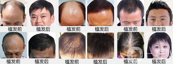 植發(fā)費(fèi)用多少錢 價(jià)格高不高？