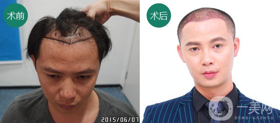 植發(fā)費(fèi)用一般是多少？植發(fā)前后