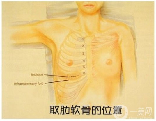 自體肋軟骨隆鼻危害有哪些？隆鼻價格