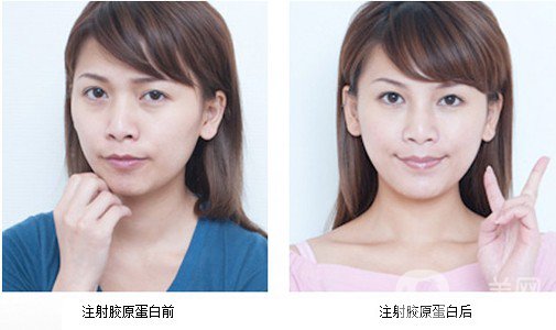 膠原蛋白針的副作用 危害有哪些？