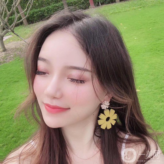 植發(fā)半年后案例 植發(fā)怎么樣？