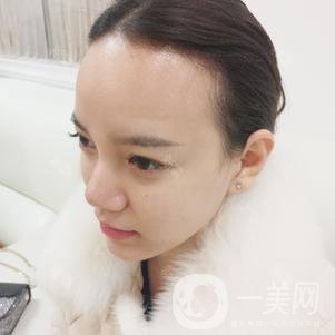 植發(fā)半年后案例 植發(fā)怎么樣？