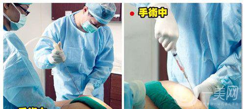 什么是抽脂手術(shù)？*果好嗎？