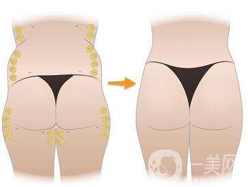 玻尿酸豐臀需要多少錢(qián)