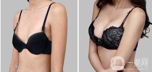 什么是乳房再造手術 乳房再造手術的原因