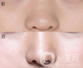 鼻翼縮小圖 鼻翼縮小有什么后遺癥嗎？