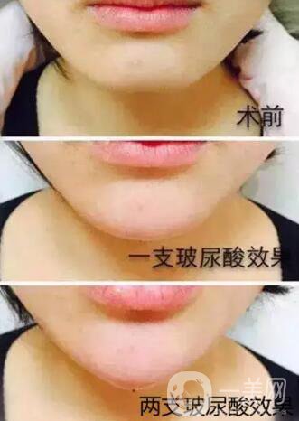 玻尿酸豐下巴需要幾針？兩針玻尿酸下巴*果圖