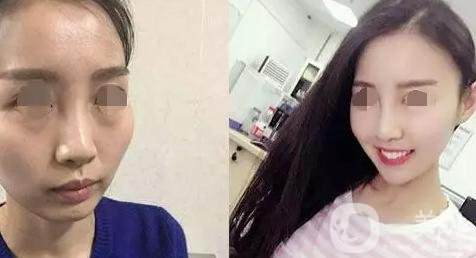 磨顴骨照片 磨顴骨*果怎么樣？