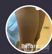 腿部環(huán)形抽脂果如何？小粗腿到筷子腿就這么簡單