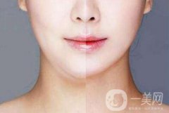 下巴抽脂有什么風(fēng)險？醫(yī)生說副作用有這些