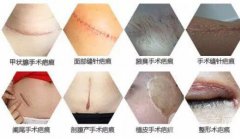 怎樣修復(fù)手術(shù)疤痕？祛疤方法有哪些？