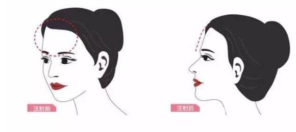 額頭自體脂肪多久消腫 額頭會(huì)不會(huì)發(fā)亮