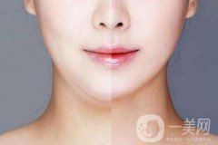雙下巴抽脂多久恢復(fù)？雙下巴抽脂七天后能相親嗎