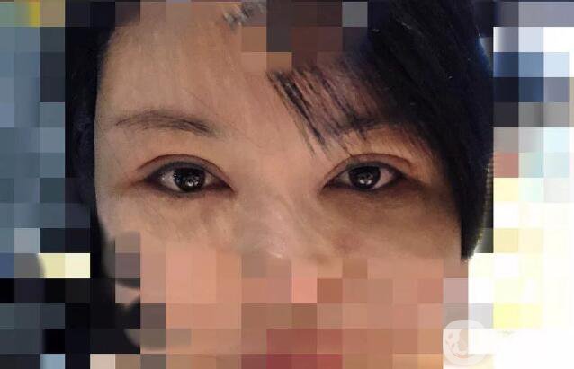 處楊曉楠雙眼皮案例 楊曉楠醫(yī)生怎么樣？