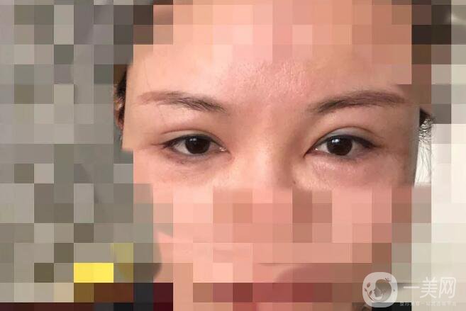 處楊曉楠雙眼皮案例 楊曉楠醫(yī)生怎么樣？