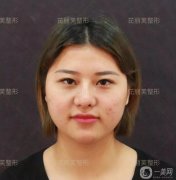 面部光纖溶脂一年后，我來(lái)說(shuō)說(shuō)這一年來(lái)的體會(huì)