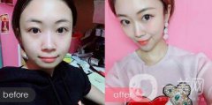 隆下巴手術(shù)前后果圖 隆下巴的風(fēng)險和恢復(fù)